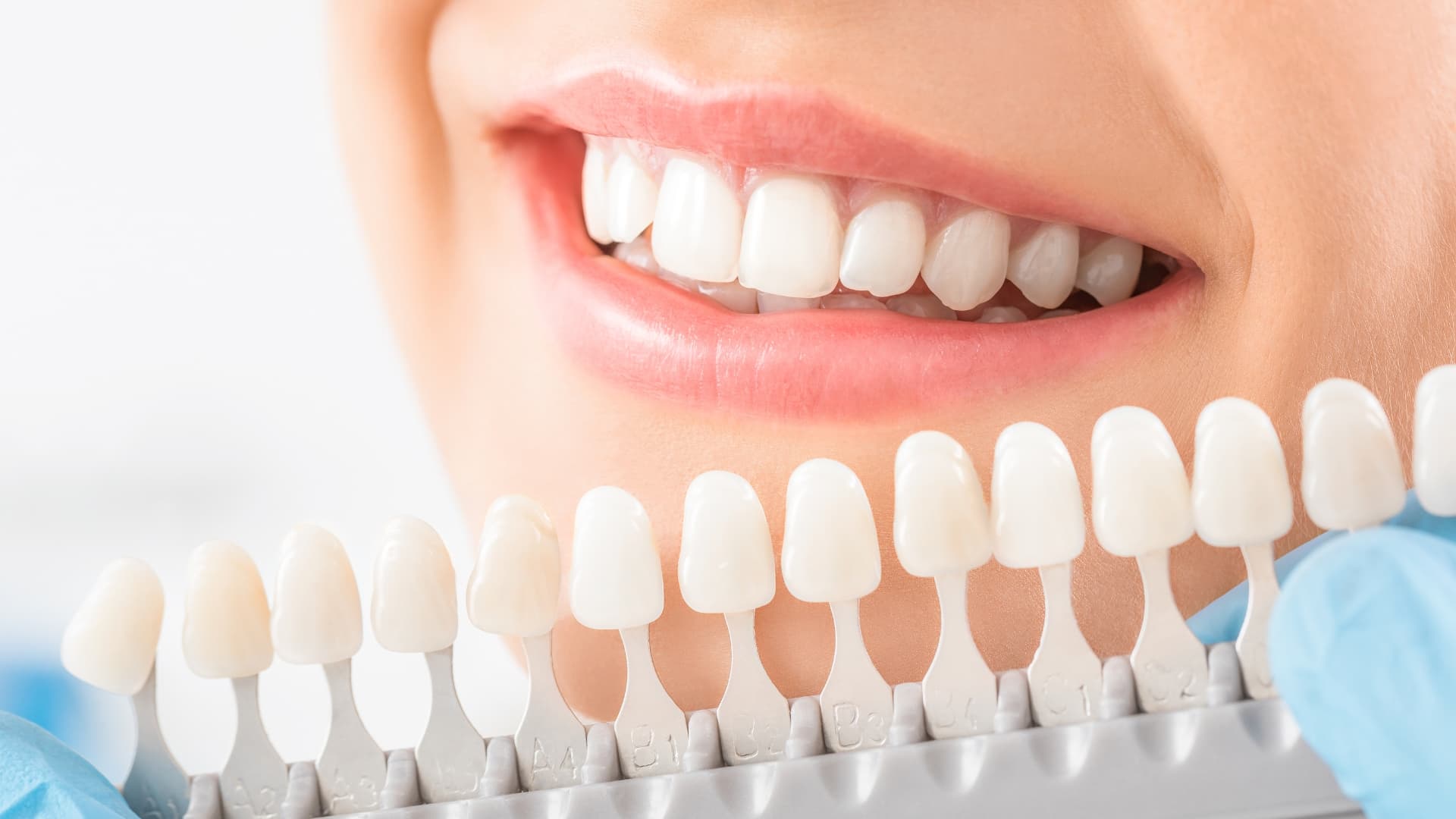 Blanqueamiento dental Badajoz