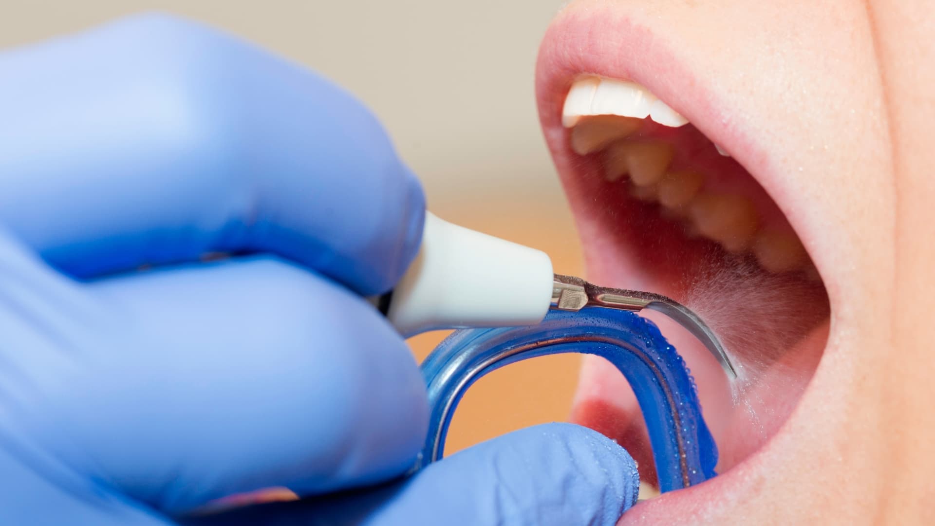 Limpieza Dental Badajoz